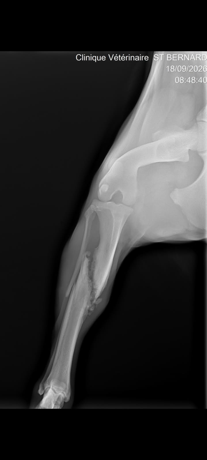 Fracture du tibia